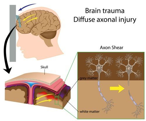 diffuse axonal injury