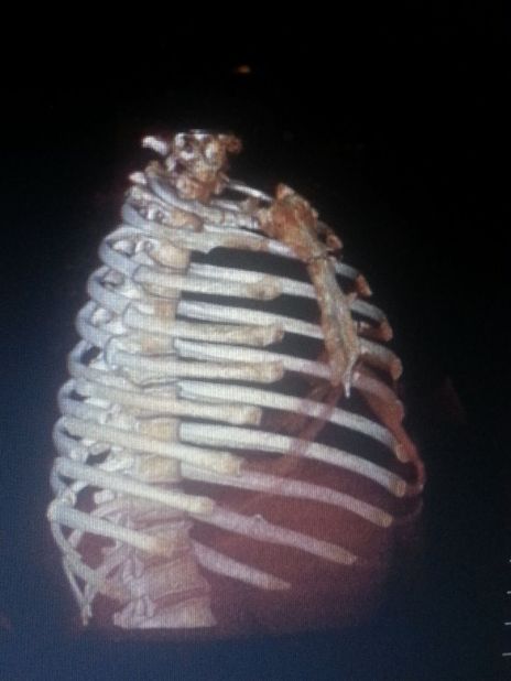 Caren Robinson - Pics PreSurgery 3