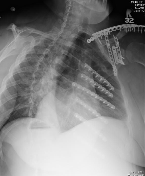 platingribandscapulajune2016